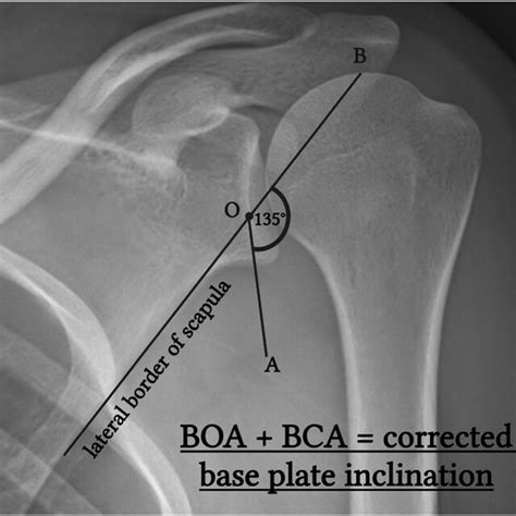 The Base Plate Orientation Angle A Plain Radiographic Technique For